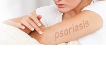 Psoriasi, un test per predeirne evoluzione in artrite