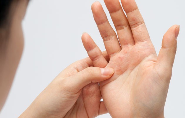 Psoriasi, un test per prevenirne evoluzione in artrite