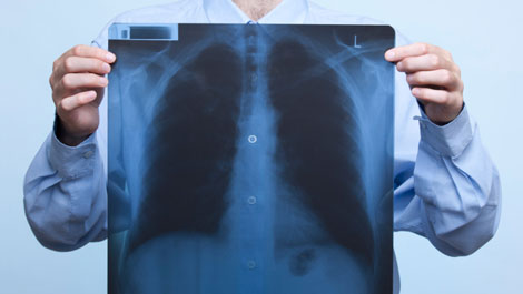 tumore polmoni scoperto nuovo meccanismo alla base dello sviluppo della malattia