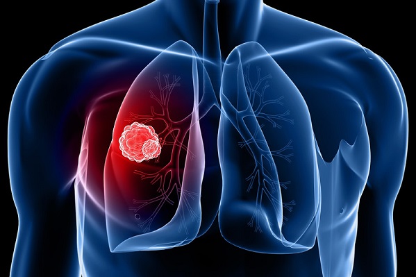 tumore polmoni scoperto nuovo meccanismo alla base dello sviluppo della malattia