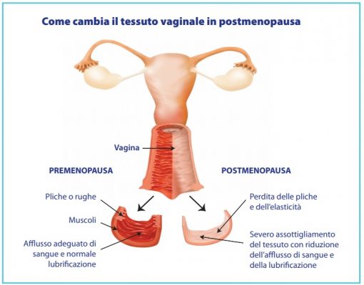 atrofia vaginale in menopausa: sintomi e cure
