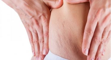 Eliminare le smagliature dopo il parto