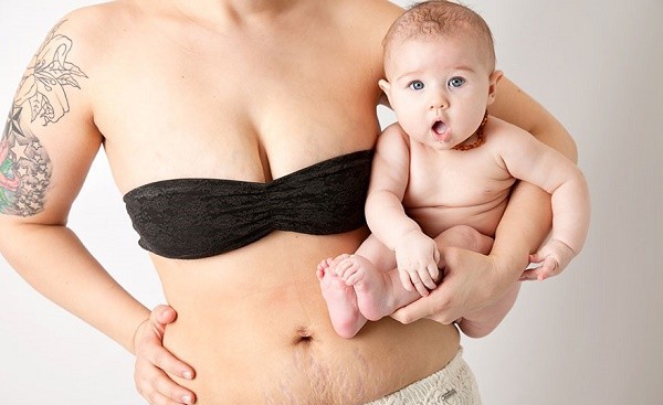 Eliminare le smagliature dopo il parto