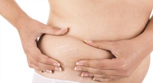 Prevenire le smagliature in gravidanza