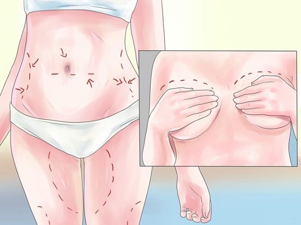 Cosa sono le smagliature della pelle