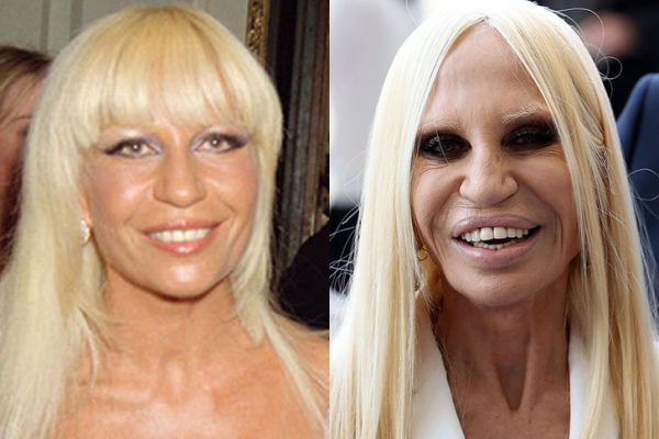errori-chirurgia-estetica-donatella-versace