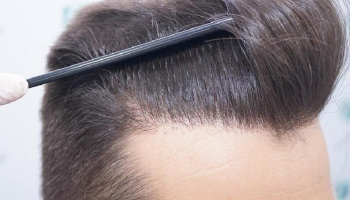 Trapianto di capelli