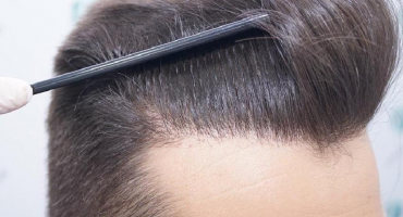 Trapianto di capelli