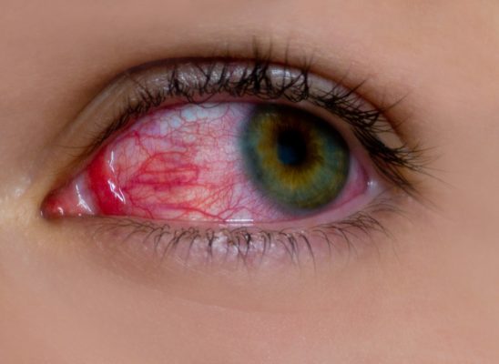Cause di perdita di sangue dagli occhi che può danneggiare la tua salute